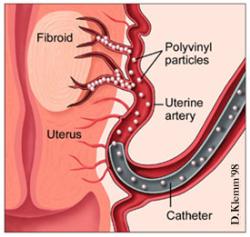 Embolisation